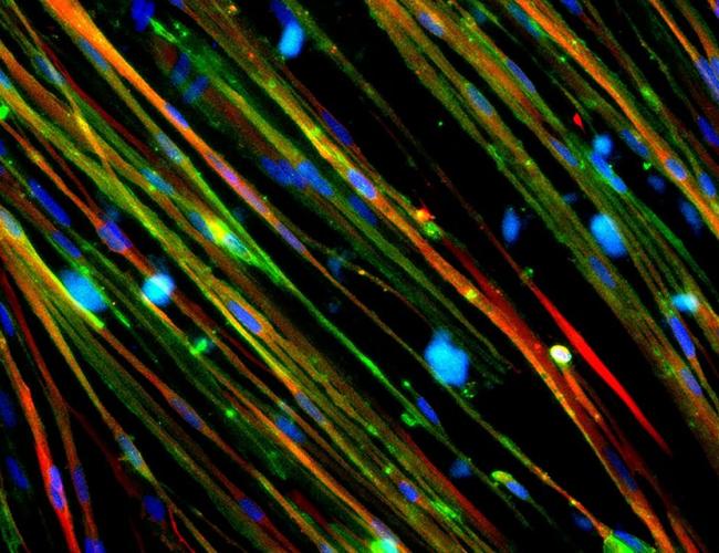 Duchenne muscular dystrophy is caused by a mutation in the gene for the dystrophin protein, which protects muscle cells from damage and loss. The restoration of dystrophin (stained green) in Duchenne muscle cells is shown above.