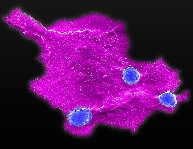 Microscopy image showing blood stem cell-engineered CAR-NKT cells (blue) attacking a human solid tumor cell (magenta)