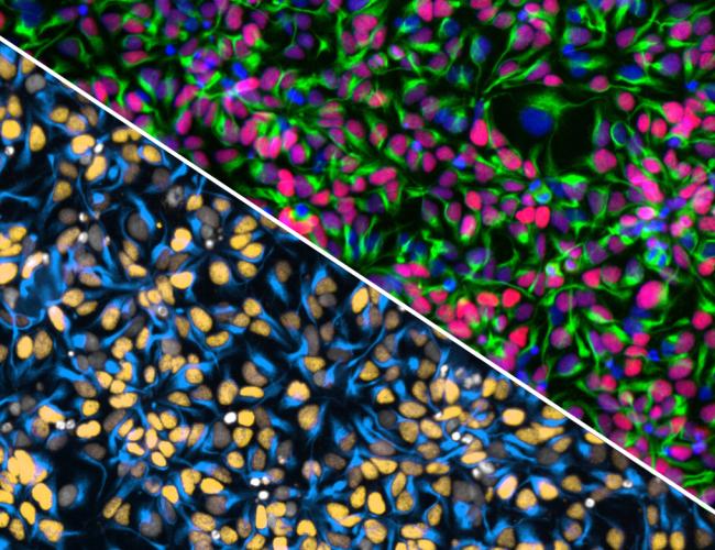 "Split fluorescence microscopy image of a neural progenitor cell village, divided diagonally. The top right shows cells with green cytoskeletal filaments and nuclei stained in pink, purple, and blue. The bottom left shows the same field with nuclei highlighted in orange, gray, and white against blue-stained cell bodies
