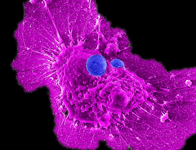 Microscopic image showing purple-colored human ovarian cell being attacked by two blue allogeneic stem cell-derived CAR-NKT cells.
