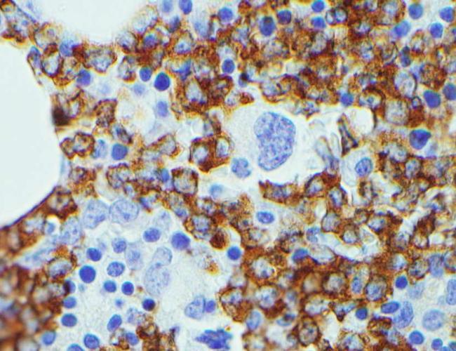 microscopy image of large leukemia cells in blue and normal blood cells in blue but smaller sized