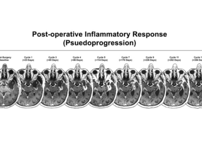 A brain scan graphic over several cycles of inflammation