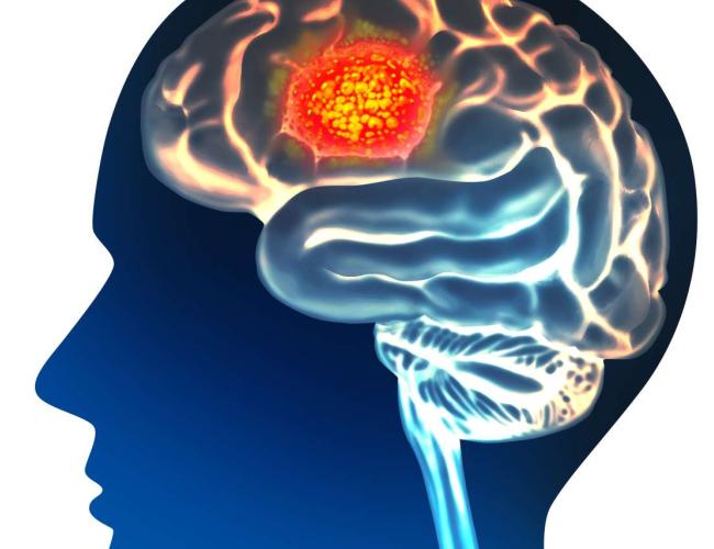 A graphic image of a brain tumor.