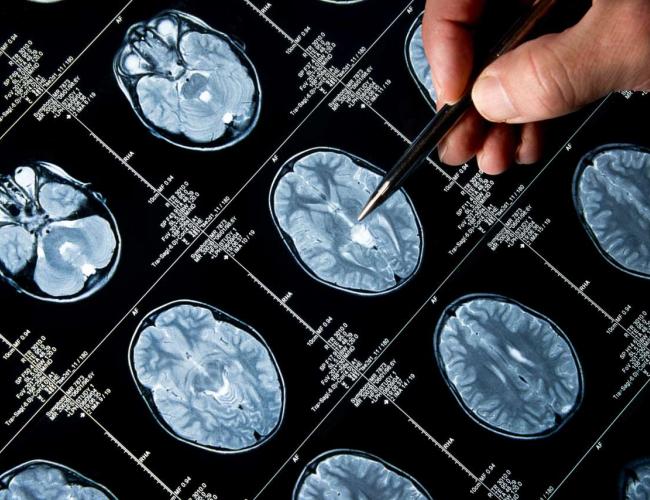 A close up of brain tumor scans.