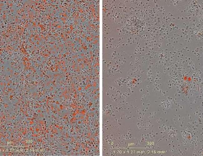 A microscopy image of melanoma cells.