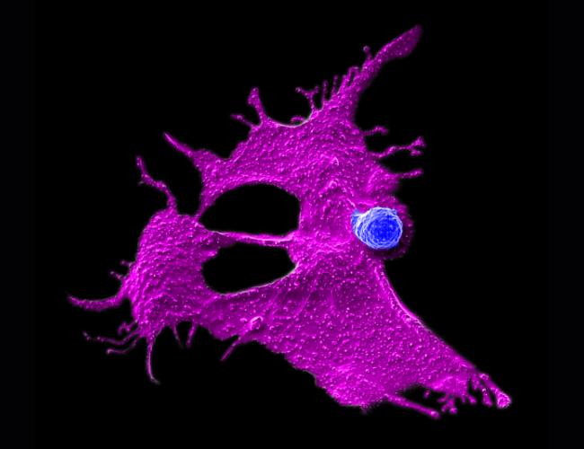 Microscopy image showing a stem cell-engineered CAR-NKT cell (blue) attacking a human solid tumor cell (magenta) against a black background