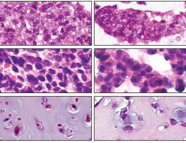 Microscopy image of desmoplastic small round cell tumor, Ewing sarcoma and chondrosarcoma. Tumors are on the left and organoids on the right. 