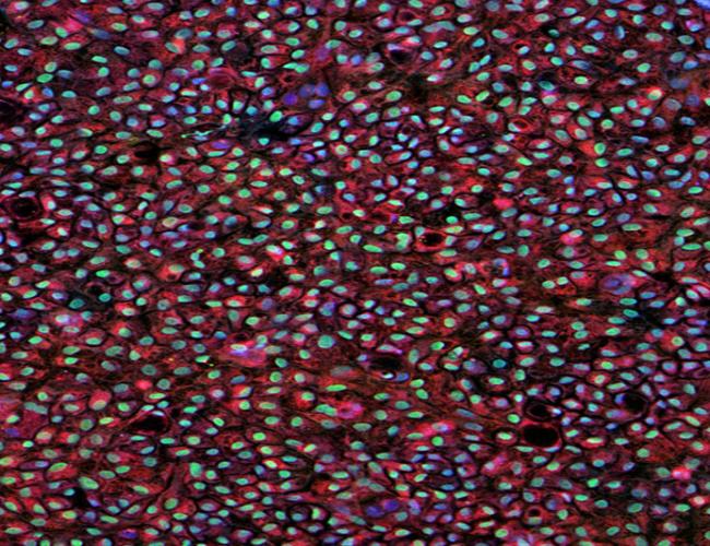 Patient-specific human induced pluripotent stem cell-derived retinal pigment epithelium cells.