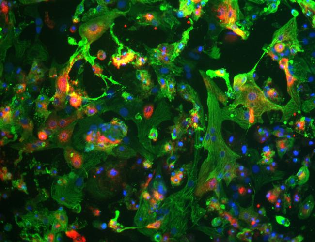 Human induced pluripotent stem cell-derived cardiomyocytes (heart cells) shown in green and blue, are infected by the novel coronavirus SARS-CoV-2 (red)