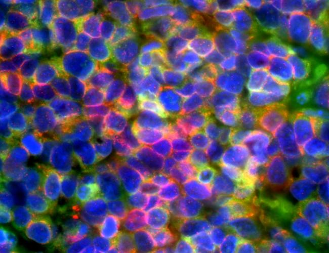 Microscopic image of small cell neuroendocrine prostate cancer: cancer cells are seen expressing diagnostic prostate cancer markers in green and red (blue color indicates the cell nucleus).
