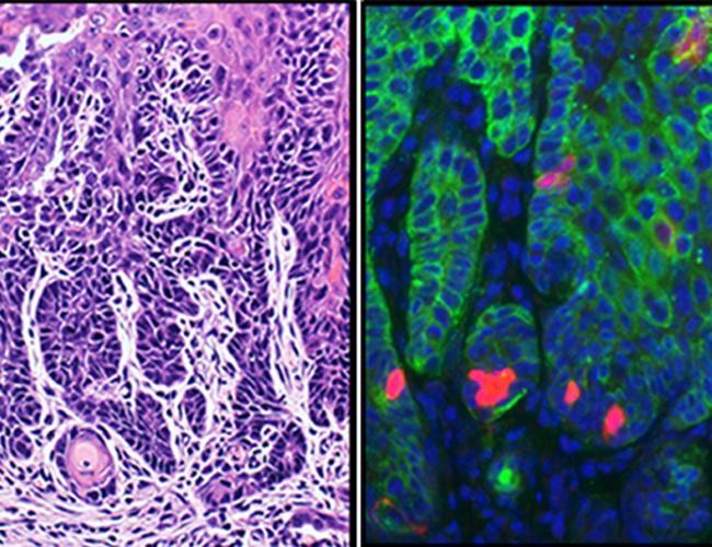 At left, head and neck squamous cell carcinoma invasive growth, and at right, cancer stem cells (shown in red) in head and neck squamous cell carcinoma.