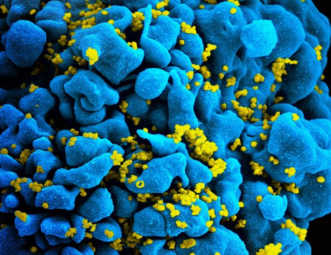 Researchers will focus on an immunotherapy known as CAR T, which uses genetically modified stem cells to target and destroy HIV-infected cells like this one. 