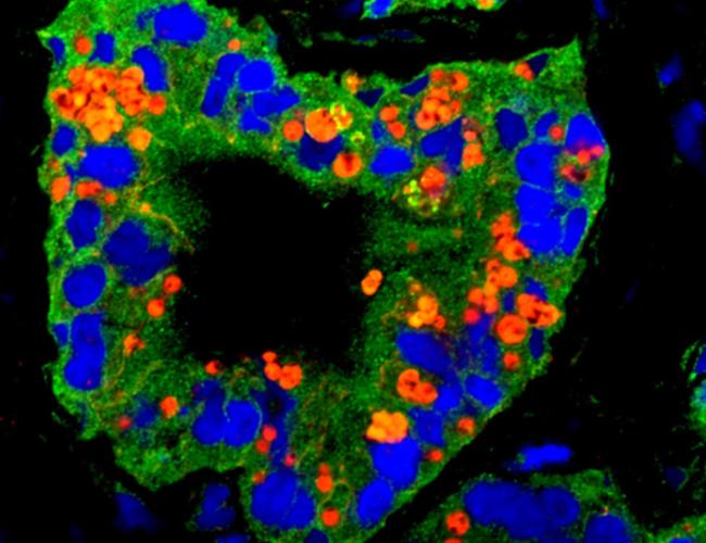 In this microscopic image of a prostate tumor, cancer cells (nuclei in blue) are seen expressing different stem cell traits (in green and red). The yellow areas indicate where the two stem cell traits are expressed together.