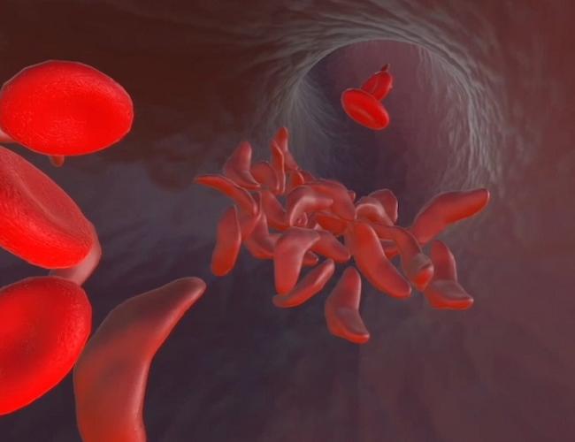 A mix of healthy red blood cells and misshapen cells caused by sickle cell disease. These sickle-shaped cells can clog arteries, producing a range of serious health effects.