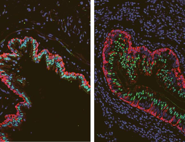 Healthy airways (left) show well-defined layers of ciliated cells (green) and basal stem cells (red). In airways affected by cystic fibrosis (right), the layers are disrupted, and scientists identified a transitioning cell type that combines properties of both stem cells and ciliated cells (red and green in the same cell).