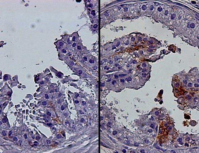 Cellular images of a young mouse prostate (left) and a prostate in an older mouse (right). The older prostate contains more luminal progenitor cells (brown).