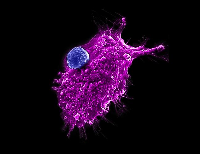 An engineered HSC-iNKT cell (blue) attacking a human tumor cell. 