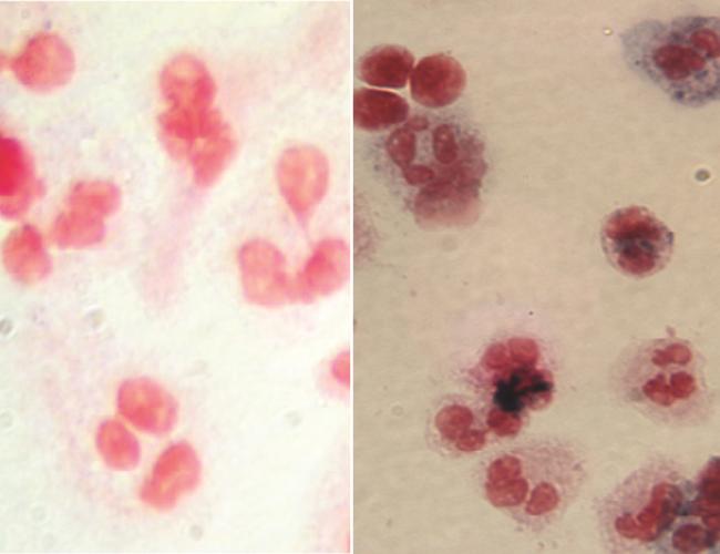 At left, image shows white blood cells (red) from one of the X-CGD clinical trial participants before gene therapy. At right, after gene therapy, white blood cells from the same patient show the presence of the chemicals (blue) needed to attack and destroy bacteria and fungus.