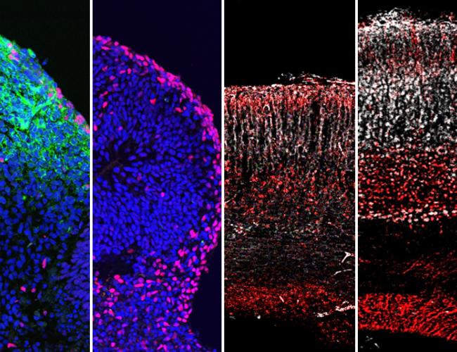 Left to right: Zika virus (green) infects and destroys the formation of neurons (pink) in human stem cell-derived brain organoids. Administration of 25HC blocks Zika infection and preserves neuron formation in the organoids. Reduced brain size and structure in a Zika-infected mouse brain. Administration of 25HC preserves mouse brain size and structure.