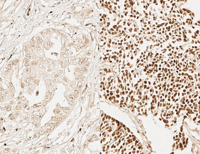 Image shows the expression of an adult stem cell signature marker (dark brown) in less aggressive lung cancer cells (left) and highly aggressive lung cancer cells (right).