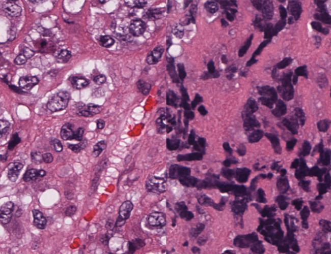 Microscopic images show a non-small cell breast cancer, left, and small cell neuroendocrine breast cancer, right. Small cell neuroendocrine cancers typically feature smaller cells and larger nuclei in relation to cell size.
