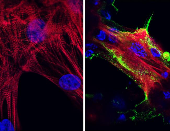 Microscope images showing (left) healthy heart muscle cells and (right) heart muscle cells that have been infected and damaged by the SARS-CoV-2 virus (in green). | Credit: UCLA Broad Stem Cell Research Center/JCI Insight