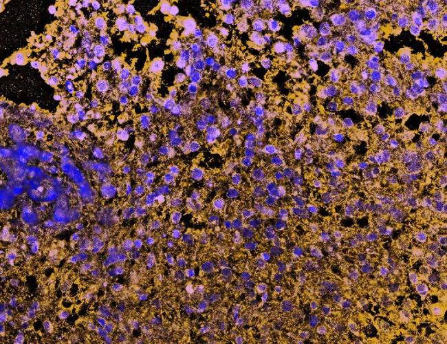Cells in a glioblastoma with the deletion in the CDKN2A gene.