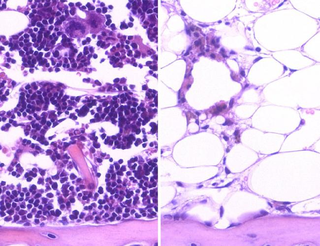 After radiation, blood cells (purple) regenerated in the bone marrow of mice that were given DKK1 intravenously (left), but not in those that received saline solution (right).
