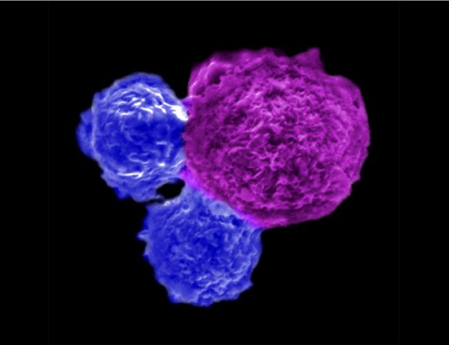 Human stem cell-engineered iNKT cells (blue) attack a human blood cancer cell (magenta).