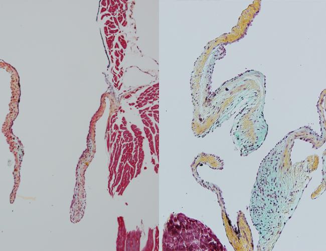 Microscopic images of a normal heart valve in a mouse, left, and a heart valve grown in a lab with heart-derived macrophages blocked, right. Without those macrophages, the valves are thick and deformed.