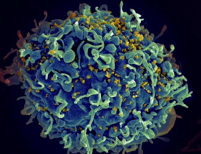 A human T cell, in blue, under attack by HIV, in yellow.