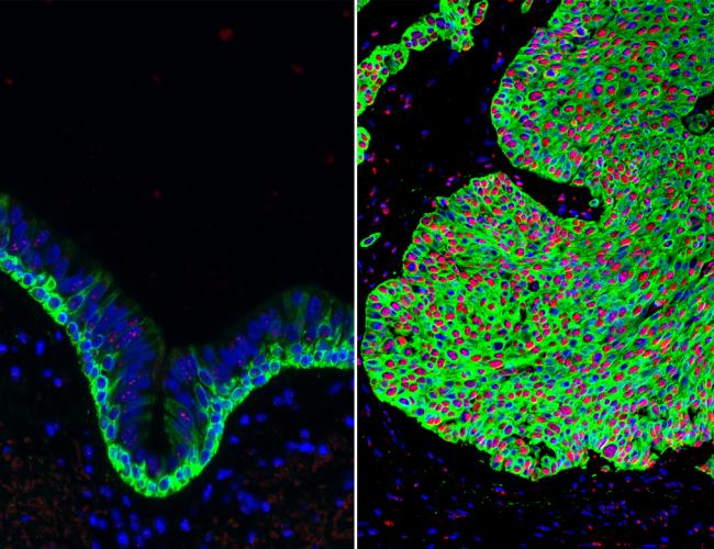 Normal airway tissue, left, and lung cancer tissue, right, with an overabundance of basal stem cells (green). The activated form of beta-catenin (red) in the lung cancer can be targeted by the Wnt Inhibitor Compound 1.