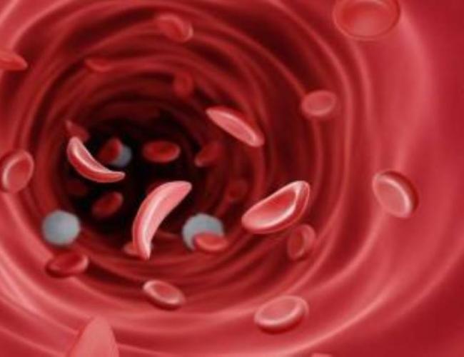 Sickle cell disease red blood cells