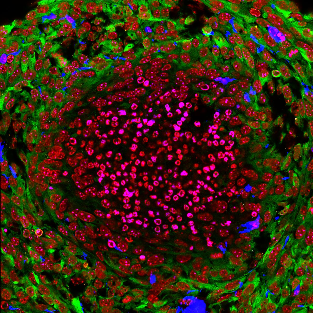 image shown here is a cross-section of a brain tumor nodule in a mouse that did not respond to therapy