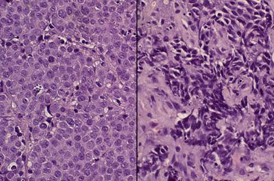 Typical prostate cancer cells (left) and neuroendocrine prostate cancer cells. The neuroendocrine cells’ disorganized appearance reflects their more aggressive nature.