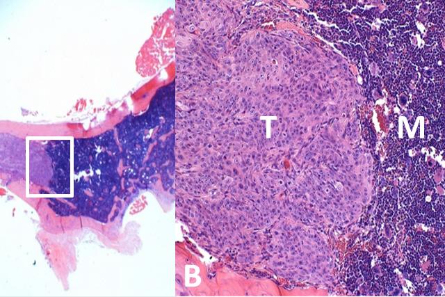 Microscopic view of a hip bone (left) and a magnified view of the bone showing the metastasized prostate cancer tumor (T), healthy bone marrow (M) and bone (B).