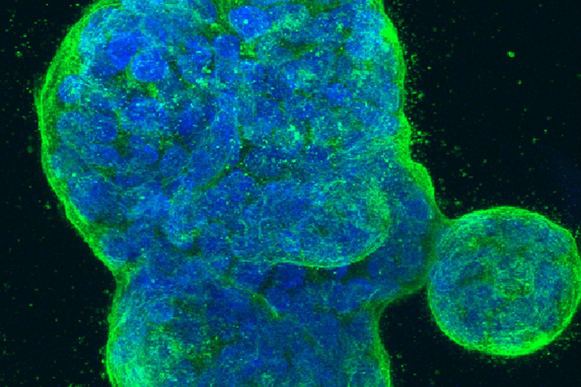 Microscopy image of 3D Three-dimensional culture of human breast cancer cells, with DNA stained blue and a protein in the cell surface membrane stained green