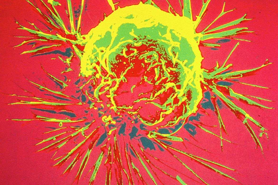 A breast cancer cell photographed by a scanning electron microscope, which produces 3-dimensional images