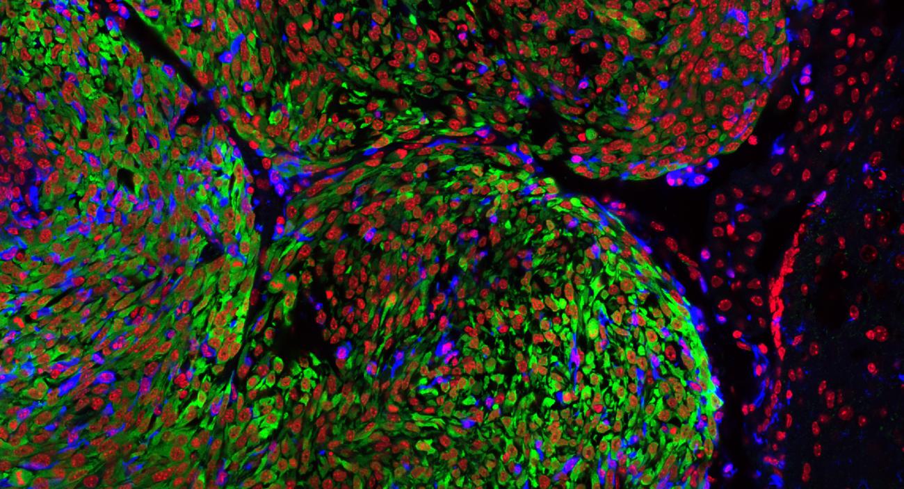 A microscopy image of cancer cells taken by UCLA scientists.