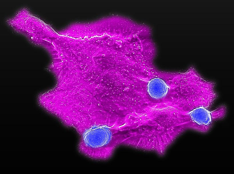 Microscopy image showing blood stem cell-engineered CAR-NKT cells (blue) attacking a human solid tumor cell (magenta)