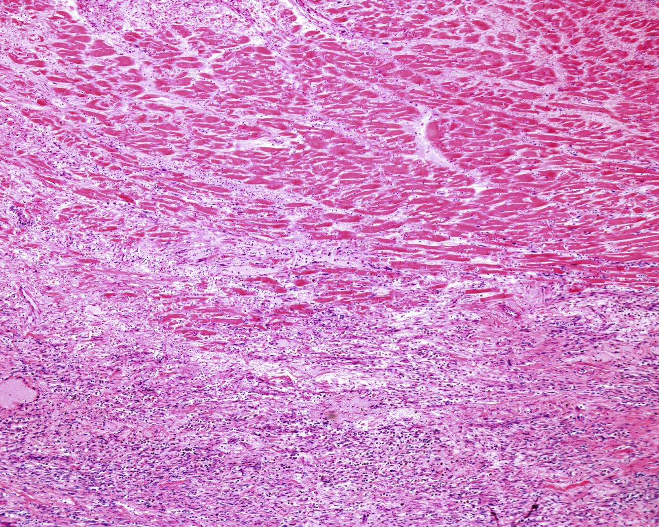 Scar tissue from a prior heart attack (lower half) meets healthier cardiac muscle (upper half). 