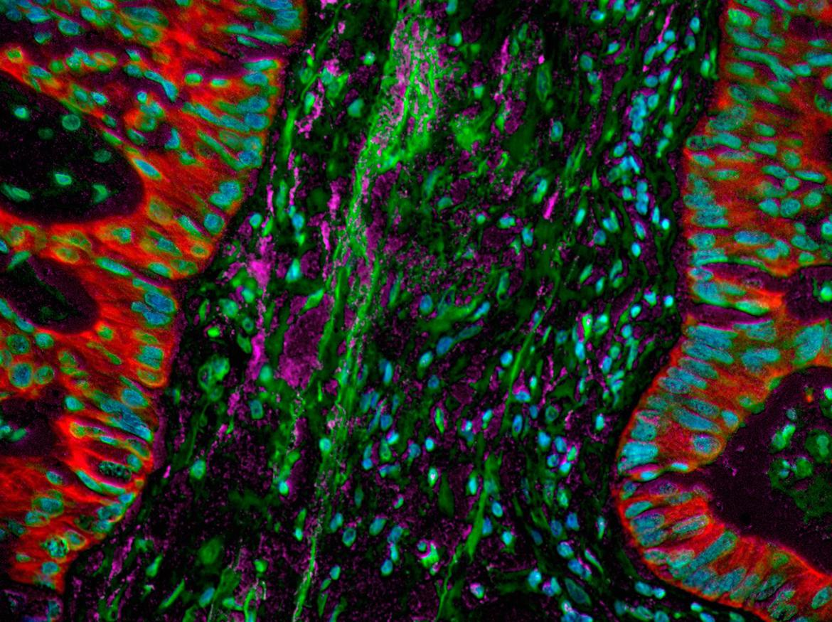 Microscopy image of lung cancer cells