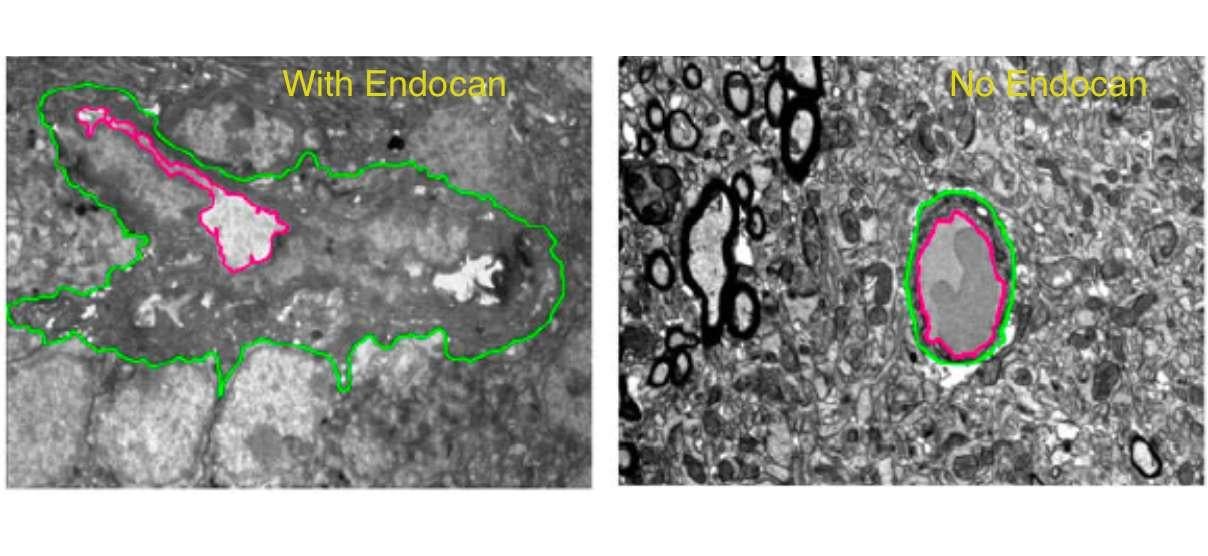 Electron micrographs of brain tumors from mice with and without endocan, illustrating that endocan affects the shape and structure of tumor blood vessels.