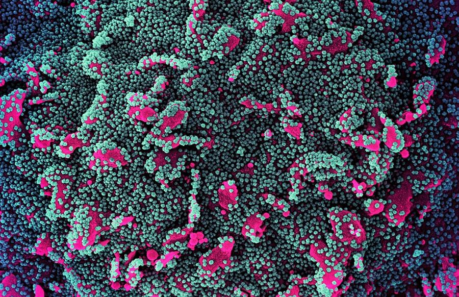 Microscope image showing a human cell (pink) heavily infected with SARS-CoV-2 virus particles (green and purple). 