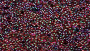 Patient-specific human induced pluripotent stem cell-derived retinal pigment epithelium cells.