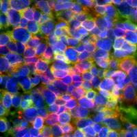 Microscopic image of small cell neuroendocrine prostate cancer: cancer cells are seen expressing diagnostic prostate cancer markers in green and red (blue color indicates the cell nucleus). Credit: Jung Wook Park & Owen Witte