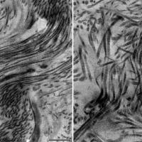Electron microscopy images showing a healthy scar containing collagen type 5 with scar fibers smoothly arranged in parallel (left) and unhealthy scar containing no collagen type 5 with a disorganized architecture with disarray of scar fibers (right).