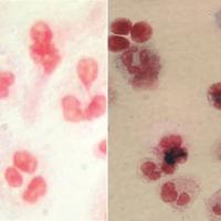 At left, image shows white blood cells (red) from one of the X-CGD clinical trial participants before gene therapy. At right, after gene therapy, white blood cells from the same patient show the presence of the chemicals (blue) needed to attack and destroy bacteria and fungus.