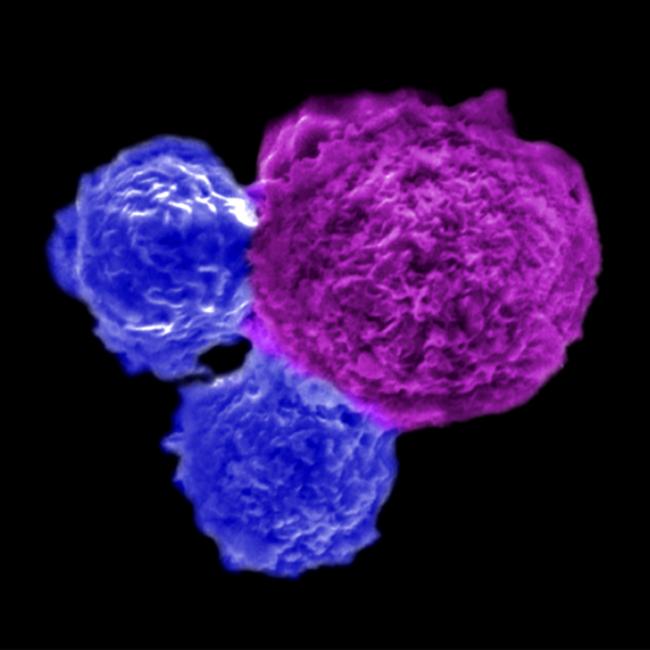 Human stem cell-engineered iNKT cells (blue) attack a human blood cancer cell (magenta).