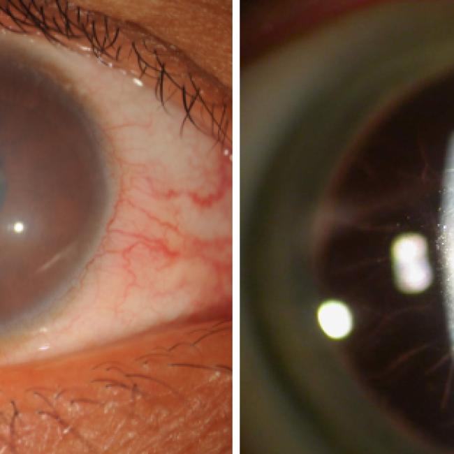Two side-by-side close-up images of an eye showing cloudy corneal changes, including a hazy gray opacity across the front of the eye and a magnified slit-lamp view with visible corneal irregularities.